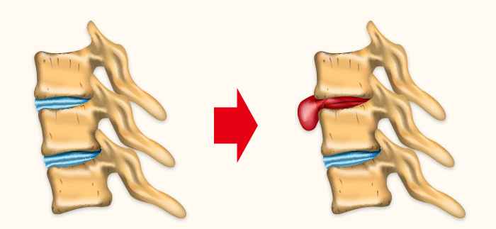ヘルニアの正体